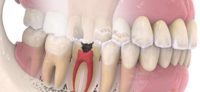 Todo lo que necesitas saber sobre la pulpitis dental.