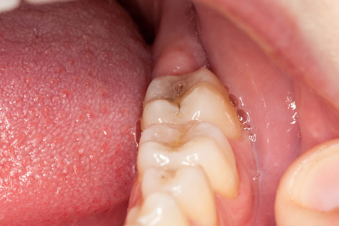 El microbioma salival como herramienta diagnóstica de la periodontitis, por la Dra. Alba Regueira-Iglesias
