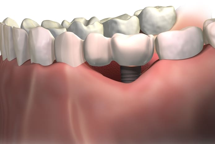 Pérdida ósea marginal alrededor de implantes dentales: comparación entre grupos emparejados de pacientes bruxistas y no bruxistas.