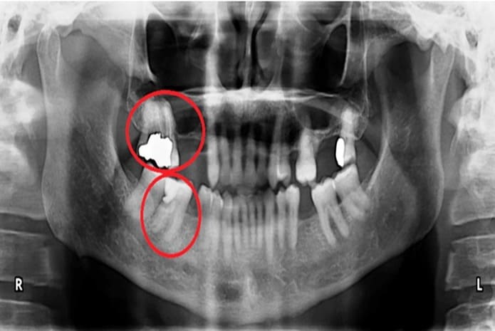 Radiografía panorámica prequirúrgica que muestra múltiples espacios edéntulos, restauraciones de amalgama, dos dientes con pulpas necróticas (ver círculos rojos) y un segundo molar superior derecho con obturación radicular.
