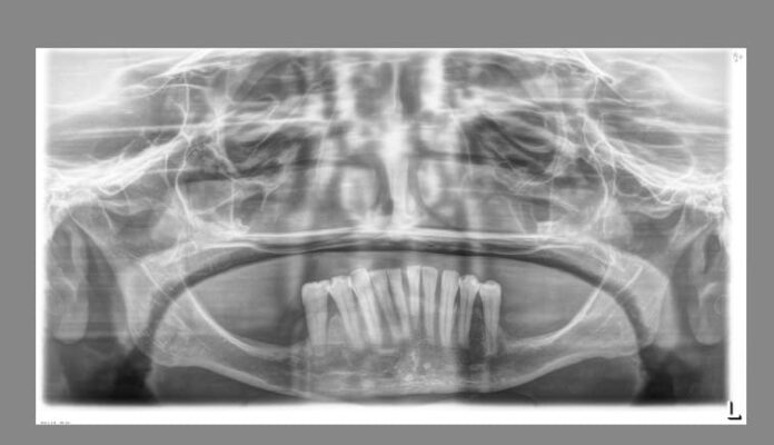 Figura 5. Radiografía inicial donde ya podemos observar la atrofia ósea en altura del maxilar superior.