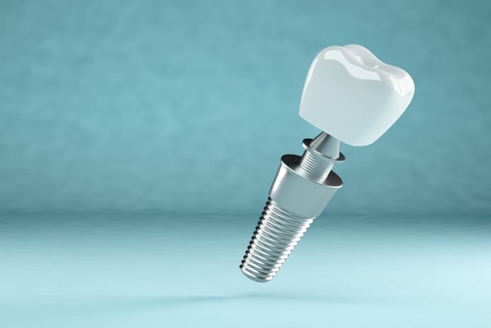 Lo que todo odontólogo debe saber sobre cómo examinar a los pacientes con implantes dentales.