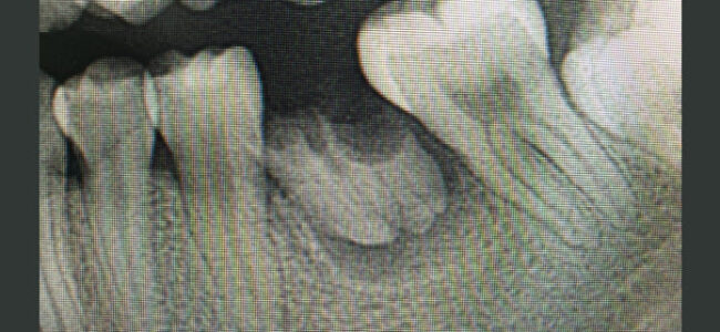 Película periapical de rayos X de la raíz de retención dental con periodontitis peri-apical del diente molar inferior izquierdo.