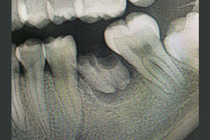 Película periapical de rayos X de la raíz de retención dental con periodontitis peri-apical del diente molar inferior izquierdo.