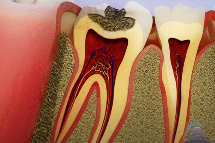 ¿Cómo curar las caries dentales?