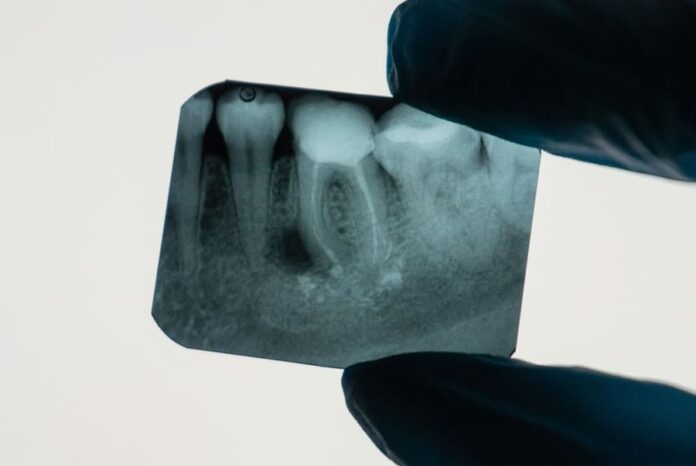 Un estudio reciente, publicado en Journal of Endodontics, ha querido evaluar la prevalencia de los abscesos periapicales agudos (AP) en pacientes con EM