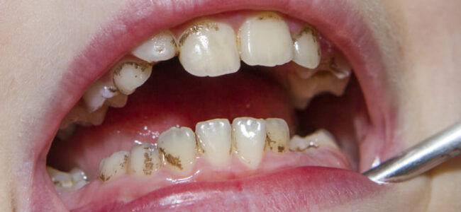 ¿Cuándo salen las manchas negras en los dientes y qué significan?