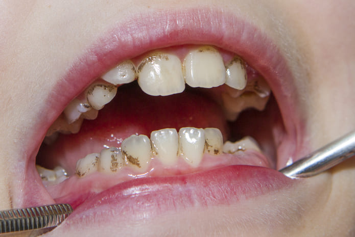¿Cuándo salen las manchas negras en los dientes y qué significan?