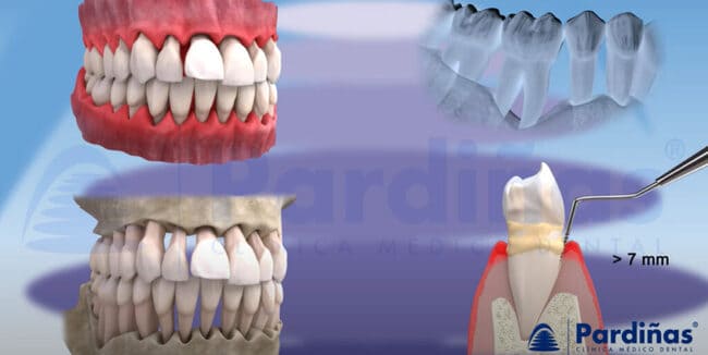 Cómo saber si tengo gingivitis y periodontitis? - Clínica Blasi