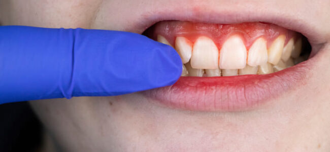 ¿Cómo saber si tienes gingivitis o periodontitis?