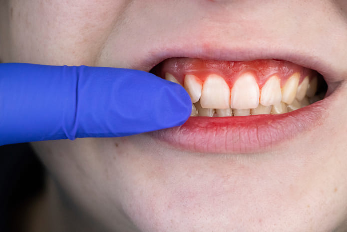 ¿Cómo saber si tienes gingivitis o periodontitis?