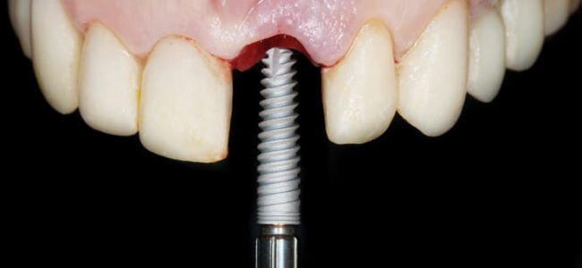 Implantes dentales vs. Puentes: El dilema de la elección en la salud bucodental