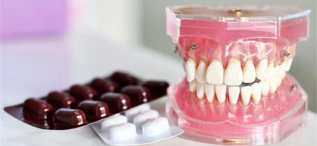 Una investigación busca proporcionar un método alternativo de administración de antibióticos para tratar la periodontitis agresiva.