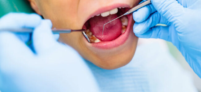 La caries dental es una afección común en la infancia que puede tener consecuencias significativas para la salud oral.
