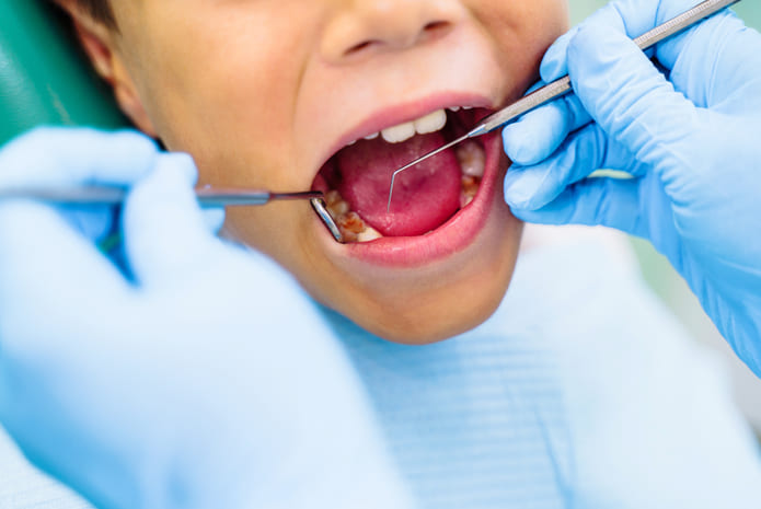 La caries dental es una afección común en la infancia que puede tener consecuencias significativas para la salud oral.