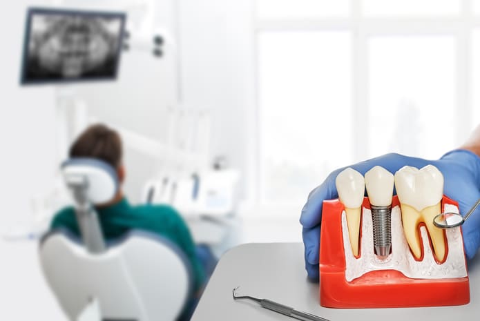 Cuando se trata de reemplazar dientes perdidos o dañados sin posibilidad de restaurarlos, los implantes dentales son una opción cada vez más popular.