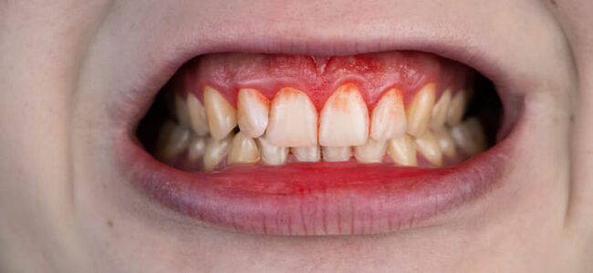 Cómo responden las distintas personas a la acumulación de placa dental.