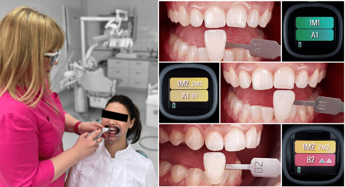La Dra. Dubravka Knezović Zlatarić durante la determinación del color dental mediante el VITA Easyshade LITE.
