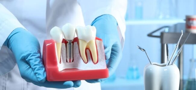 ¿Poner implantes dentales duele?