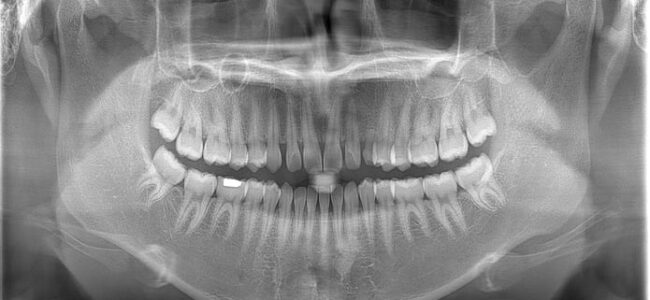 Objetivo principal determinar la frecuencia de los caninos maxilares impactados y analizar las diferencias significativas entre variables categóricas, como el género y la posición de los dientes afectados.