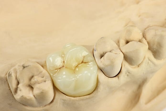 Restauraciones con implantes y su impacto en dientes y tejidos