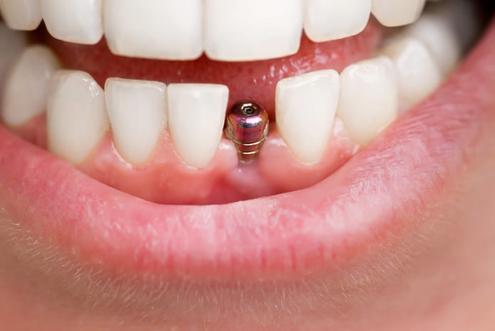 Los implantes dentales inmediatos son aquellos que se colocan inmediatamente después de la extracción del diente original
