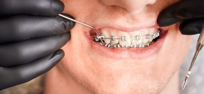 Un tratamiento de ortodoncia oscila entre un año o año y medio, dependiendo del caso individual de cada paciente.