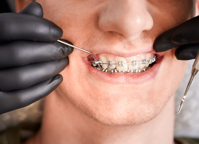 Un tratamiento de ortodoncia oscila entre un año o año y medio, dependiendo del caso individual de cada paciente.