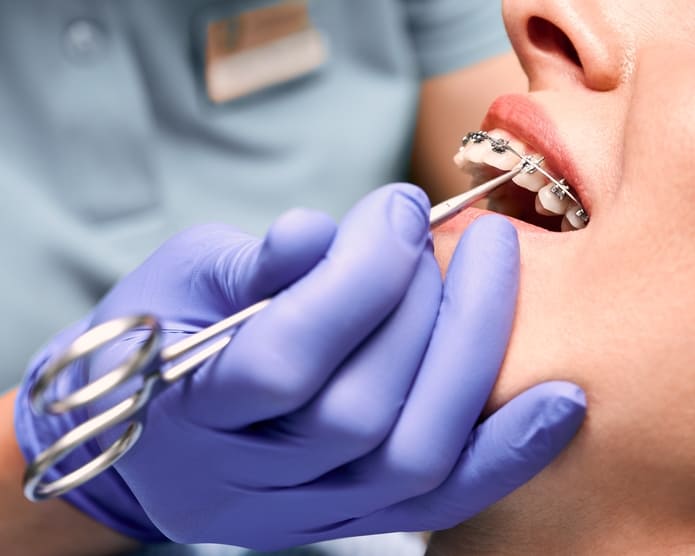 Después de la colocación o ajuste de los brackets, sí puede experimentarse incomodidad en los dientes.