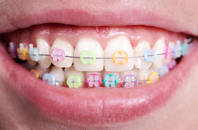 Gomas de ortodoncia, elementos habituales para lograr una sonrisa perfecta y una correcta alineación dental.