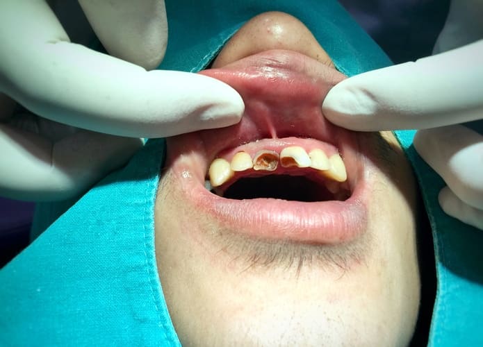 Cerámica bioactiva a base de silicato de calcio para el tratamiento de dientes permanentes en adultos con síntomas de pulpitis irreversible.
