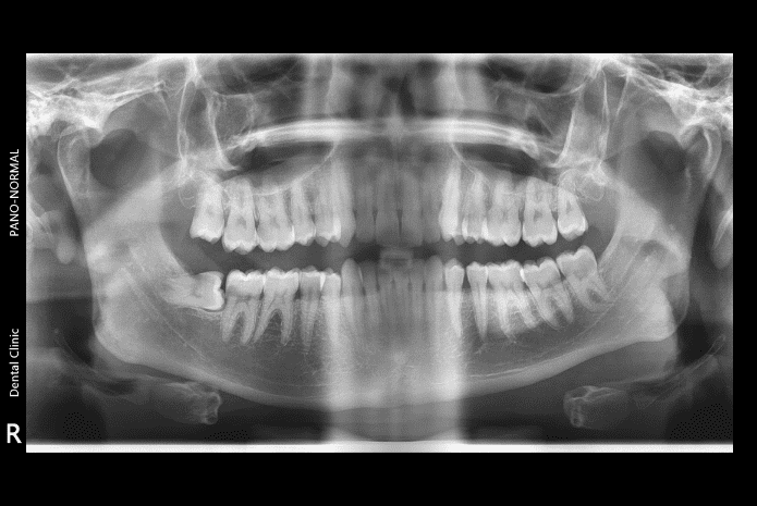 Caso clínico complejo tratado con ortodoncia invisible.
