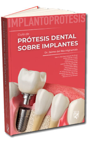 Implantoprótesis. Guía de prótesis dental sobre implantes