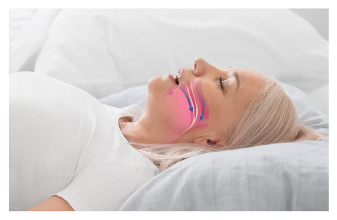 Aparatos de reposicionamiento mandibular hechos a medida que se utilizan para reposicionar la mandíbula y la lengua durante el sueño.