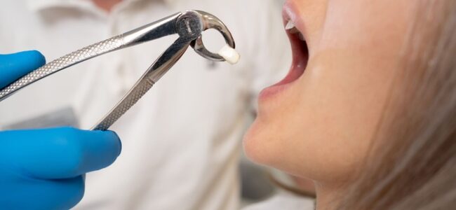 Extracciones dentales sin dolor. Infiltración local vs. bloqueo del nervio alveolar inferior.
