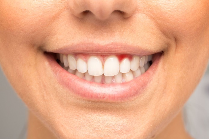 Efectos de los probióticos orales en pacientes con gingivitis o periodontitis (y II)