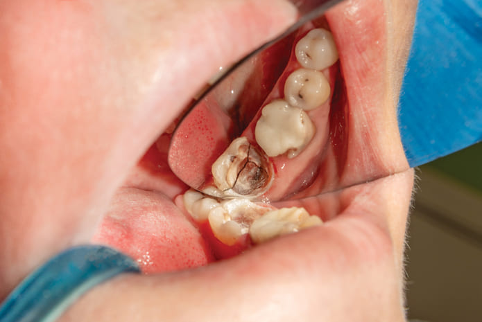 Revisión tipos de tratamientos y dientes fracturados.