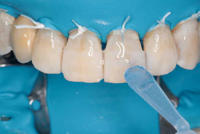 Detección precoz y tratamiento de la recidiva de la discoloración dental tras un tratamiento de blanqueamiento