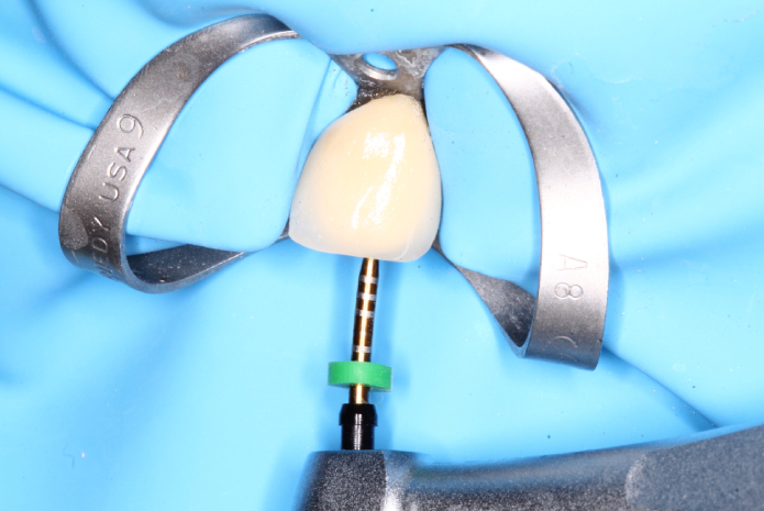 Uso de los nuevos cementos biocerámicos selladores para el retratamiento de conductos