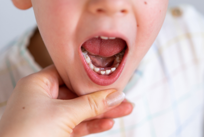 cirugía de frenillo lingual