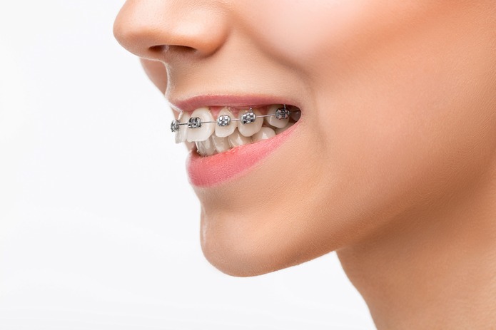 ¿Cuáles son los efectos secundarios de los brackets?
