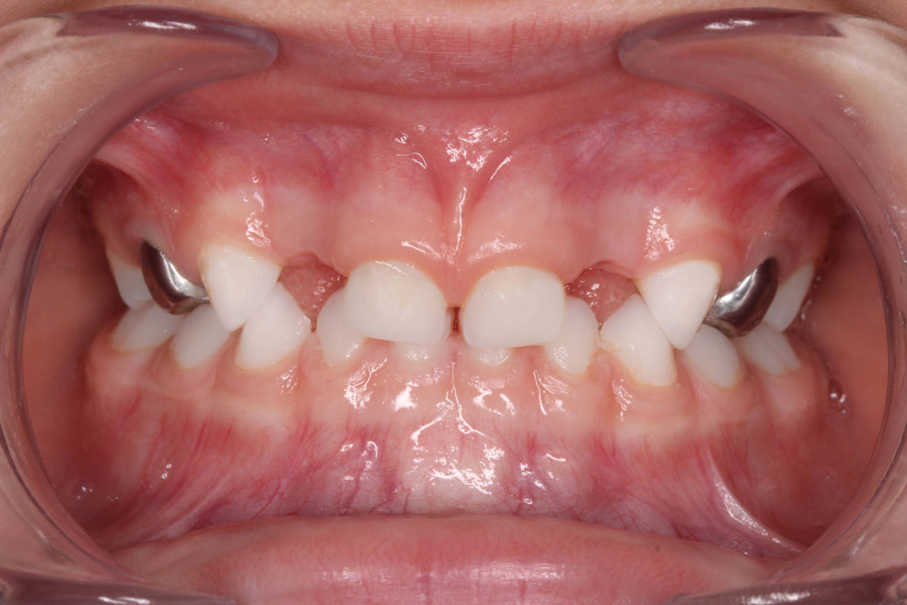 Prótesis pediátricas con escáner intraoral.