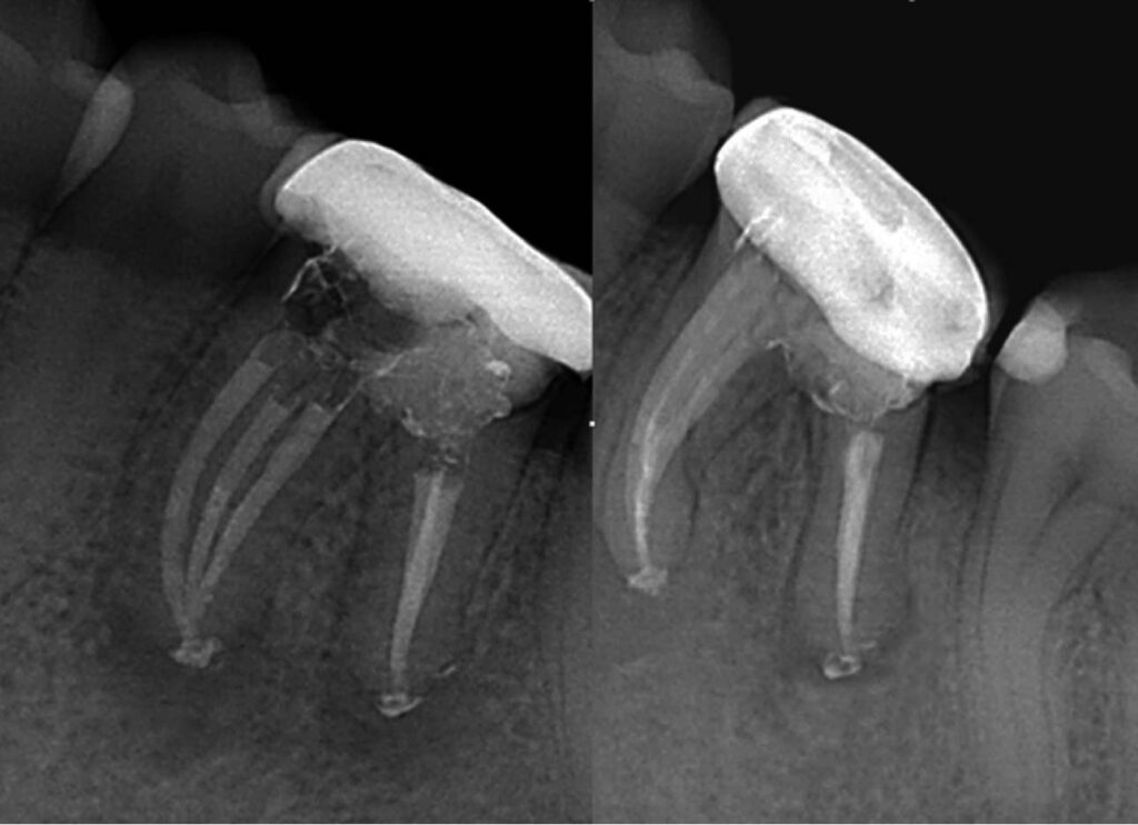Figura 7. Implante instalado y al que se le realizará una técnica de manipulación del tejido vestibular para mejorar el perfil de emergencia