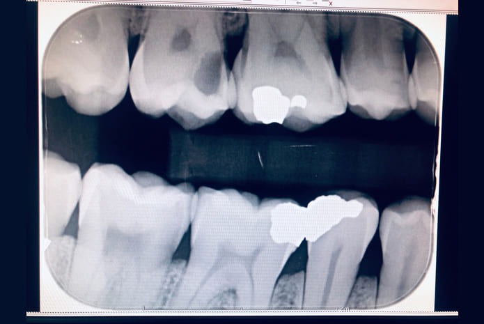 Detección de caries alrededor de restauraciones mediante inteligencia artificial con radiografías de aleta de mordida.