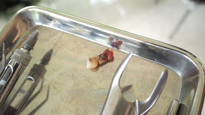 Cómo estas opciones influyen la pulpectomía y la extracción dental en la calidad de vida relacionada con la salud bucal de los niños.