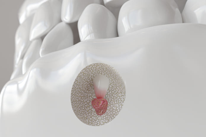 Qué es la apicectomía, cuándo se realiza y pautas a seguir tras la intervención.