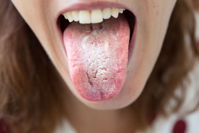 ¿Qué es la candidiasis oral?