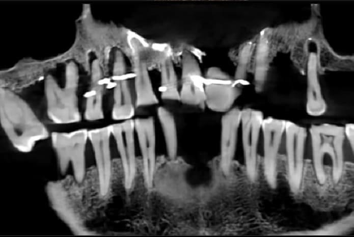 Así se usó el hilo de oro para unir los dientes flojos a causa de la periodontitis.