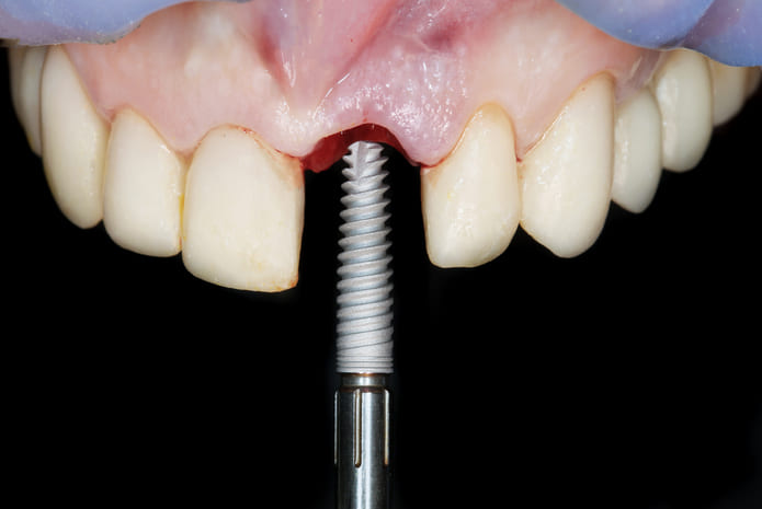 Implantes dentales vs. Puentes: El dilema de la elección en la salud bucodental