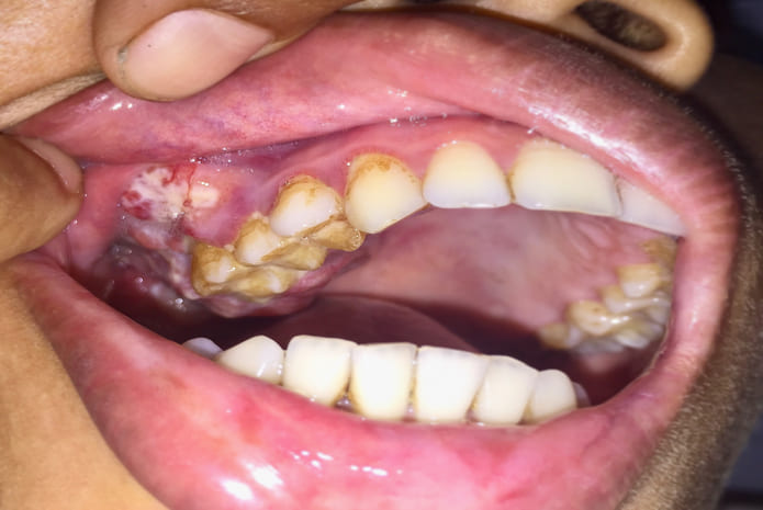 Revisión sistemática que se centró en analizar el papel de las proteínas de choque térmico (HSP) en la progresión tumoral y la metástasis en el carcinoma oral de células escamosas, que afecta la salud y la supervivencia de los pacientes.